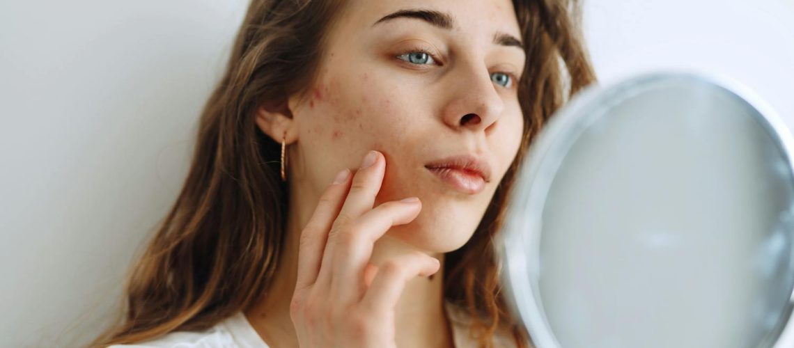 Acné : pourquoi revient-elle en hiver ? Acné : pourquoi revient-elle en hiver ?