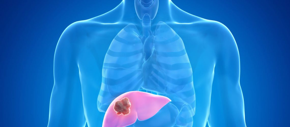 Tout savoir sur l’angiome hépatique : causes, symptômes et traitements Tout savoir sur l'angiome hépatique : causes, symptômes et traitements